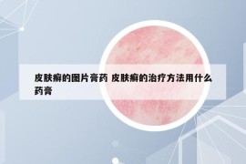 皮肤癣的图片膏药 皮肤癣的治疗方法用什么药膏