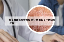 脖子后面长癣特别痒 脖子后面长了一大块癣,干痒