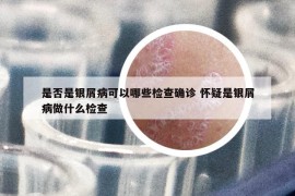 是否是银屑病可以哪些检查确诊 怀疑是银屑病做什么检查