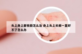 头上身上都有藓怎么治 身上头上长癣一直好不了怎么办