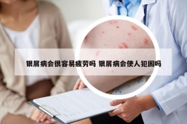 银屑病会很容易疲劳吗 银屑病会使人犯困吗