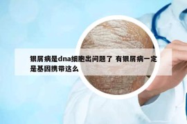 银屑病是dna细胞出问题了 有银屑病一定是基因携带这么