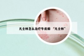 凡士林怎么治疗牛皮癣 “凡士林”