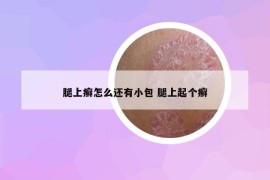 腿上癣怎么还有小包 腿上起个癣