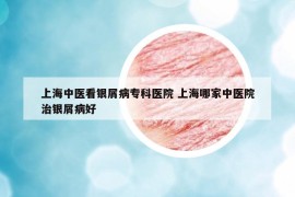 上海中医看银屑病专科医院 上海哪家中医院治银屑病好