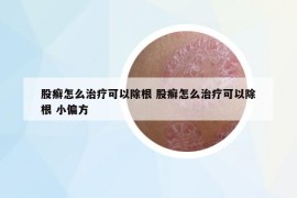 股癣怎么治疗可以除根 股癣怎么治疗可以除根 小偏方