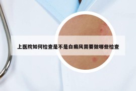 上医院如何检查是不是白癜风需要做哪些检查