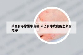 头里有寻常型牛皮癣 头上有牛皮病癣怎么治疗好