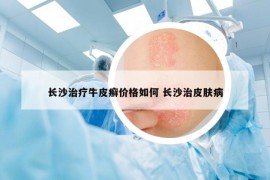 长沙治疗牛皮癣价格如何 长沙治皮肤病