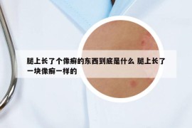 腿上长了个像癣的东西到底是什么 腿上长了一块像癣一样的