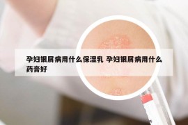 孕妇银屑病用什么保湿乳 孕妇银屑病用什么药膏好