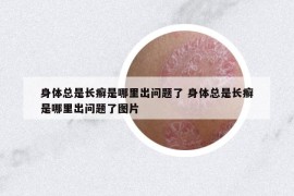 身体总是长癣是哪里出问题了 身体总是长癣是哪里出问题了图片