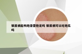 银屑病能枸地录雷他定吗 银屑病可以吃地瓜吗