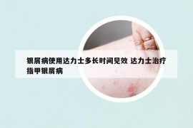 银屑病使用达力士多长时间见效 达力士治疗指甲银屑病