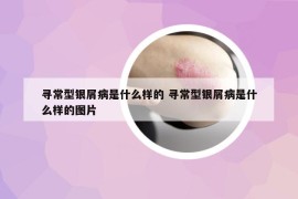 寻常型银屑病是什么样的 寻常型银屑病是什么样的图片