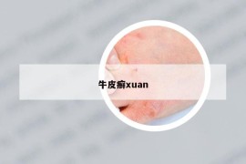 牛皮癣xuan