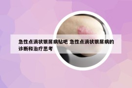 急性点滴状银屑病贴吧 急性点滴状银屑病的诊断和治疗思考