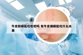 牛皮肤癣能吃枇杷吗 有牛皮病癣能吃什么水果