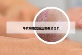 牛皮癣康复后还需要忌口么