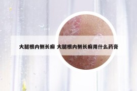 大腿根内侧长癣 大腿根内侧长癣用什么药膏