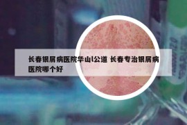 长春银屑病医院华山l公道 长春专治银屑病医院哪个好