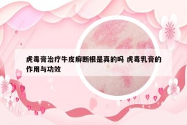 虎毒膏治疗牛皮癣断根是真的吗 虎毒乳膏的作用与功效