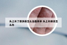 头上长了很多藓怎么治最简单 头上长癣该怎么办