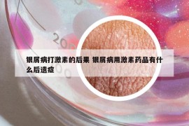 银屑病打激素的后果 银屑病用激素药品有什么后遗症