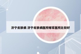 济宁皮肤病 济宁皮肤病医院哪家医院比较好