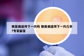 银屑病遗传下一代吗 银屑病遗传下一代几率?专家解答