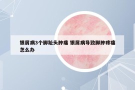 银屑病3个脚趾头肿痛 银屑病导致脚肿疼痛怎么办