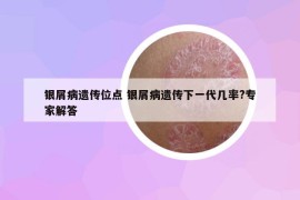 银屑病遗传位点 银屑病遗传下一代几率?专家解答