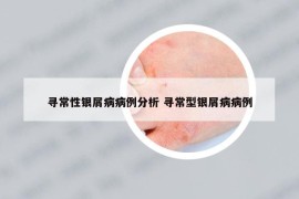 寻常性银屑病病例分析 寻常型银屑病病例