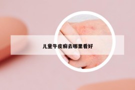 儿童牛皮癣去哪里看好