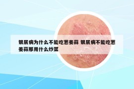 银屑病为什么不能吃葱姜蒜 银屑病不能吃葱姜蒜那用什么炒菜