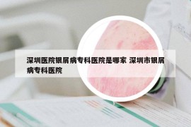 深圳医院银屑病专科医院是哪家 深圳市银屑病专科医院