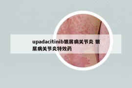 upadacitinib银屑病关节炎 银屑病关节炎特效药