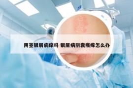 阴茎银屑病痒吗 银屑病阴囊瘙痒怎么办