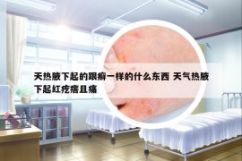 天热腋下起的跟癣一样的什么东西 天气热腋下起红疙瘩且痛