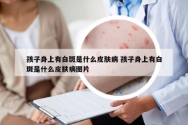 孩子身上有白斑是什么皮肤病 孩子身上有白斑是什么皮肤病图片