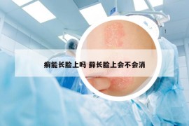 癣能长脸上吗 藓长脸上会不会消