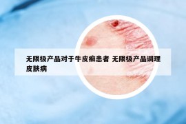 无限极产品对于牛皮癣患者 无限极产品调理皮肤病