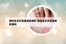 慢性皮炎改变是银屑病吗 慢性皮炎改变是银屑病吗