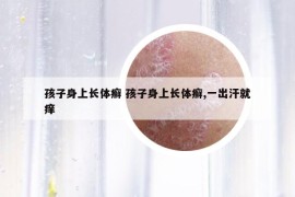 孩子身上长体癣 孩子身上长体癣,一出汗就痒