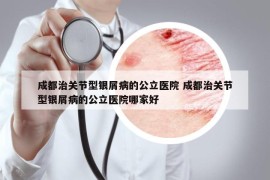 成都治关节型银屑病的公立医院 成都治关节型银屑病的公立医院哪家好