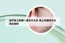 治疗身上的癣一直长什么办 身上长癣吃什么药比较好