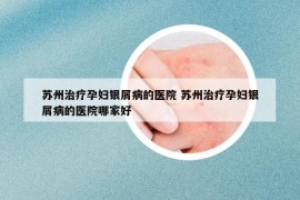 苏州治疗孕妇银屑病的医院 苏州治疗孕妇银屑病的医院哪家好