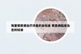 衡量银屑病治疗改善的金标准 银屑病临床治愈的标准