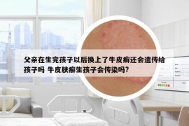 父亲在生完孩子以后换上了牛皮癣还会遗传给孩子吗 牛皮肤癣生孩子会传染吗?