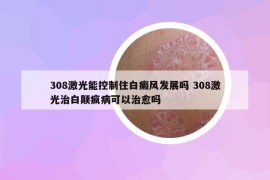 308激光能控制住白癜风发展吗 308激光治白颠疯病可以治愈吗